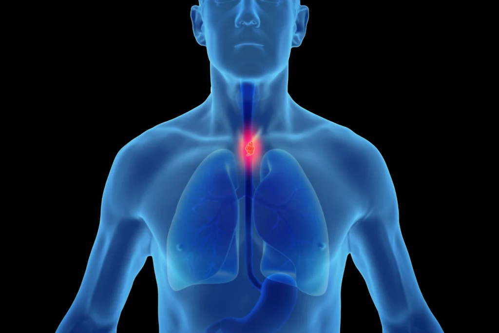 A diagnosis of esophageal cancer can be overwhelming for patients and their families. Concerns regarding treatment options, outcomes and the road ahead are but natural. When esophageal cancer is suspected or diagnosed, a detailed evaluation is carried out to confirm the diagnosis and stage. A personalized treatment plan is then formulated by a multidisciplinary team based on the patient’s overall health, stage and individual goals I am Dr. Ajay Simha, Consultant Surgical Oncologist (Cancer Surgeon) and this page gives an overview of esophageal cancer- right from symptoms and evaluation to treatment options. What Is Esophageal Cancer?