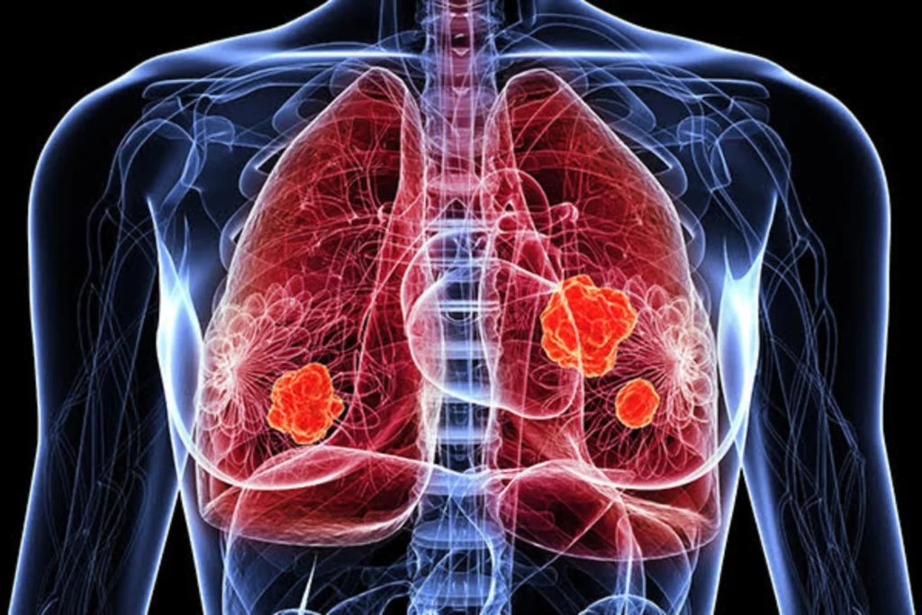 What Is Lung Cancer?