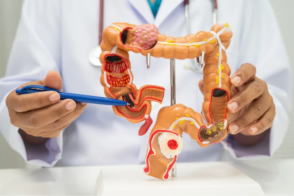 What Is Colon Cancer?